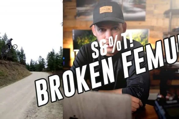 broken femur
